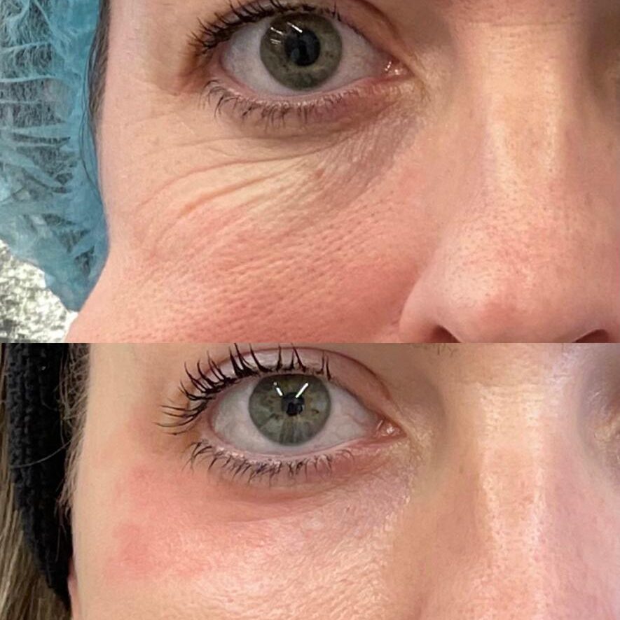 Tratamento de olheiras-antes-e-depois