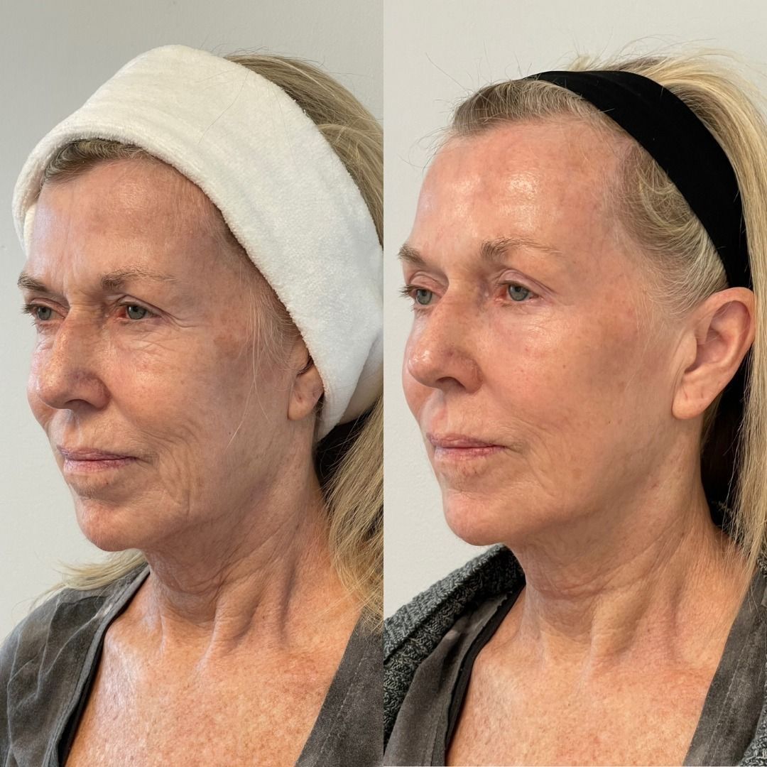 ultraformer-antes-e-depois