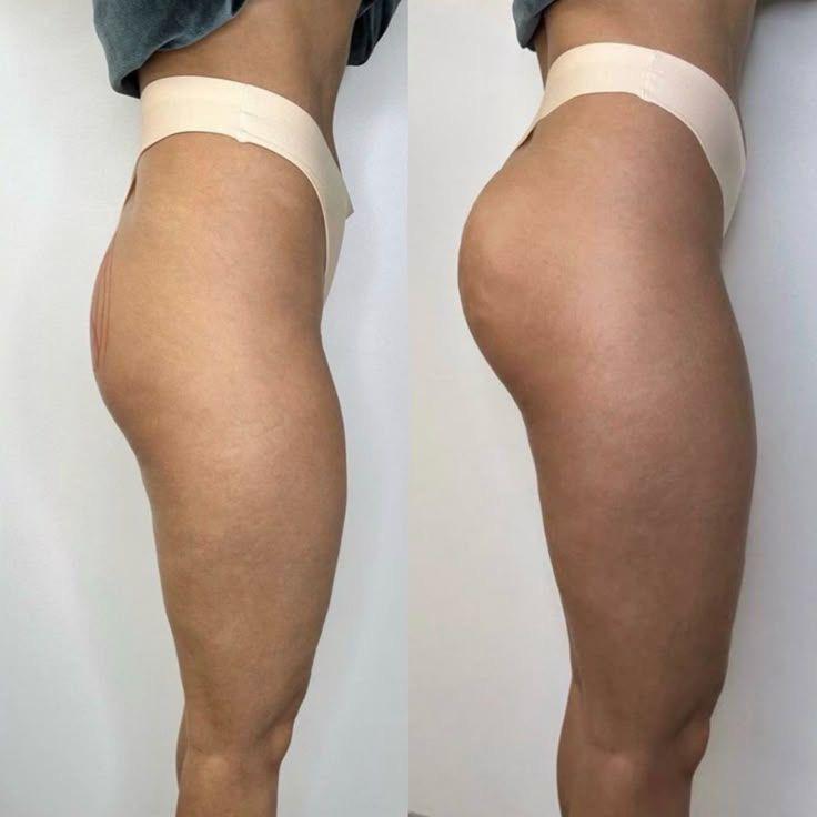  Harmonização de Glúteos