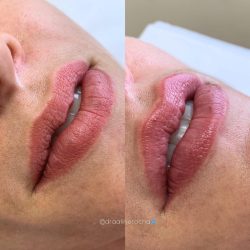 Preenchimento labial