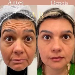 bioestimulador-antes-e-depoisl