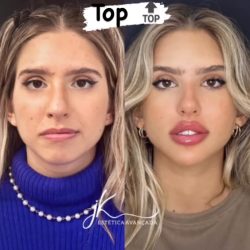 bioestimulador-de-colageno-e-preenchimento-labial