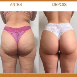 bioestimulador-de-colageno-gluteo