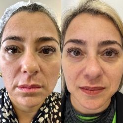 bioestimulador-de-colageno-rosto