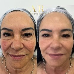 bioestimulador-promoção