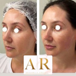 harmonizacao-facial-antes-e-depois