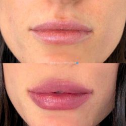preenchimento-labial-antes-e-depois (1)