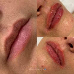 preenchimento-labial-antes-e-depois (3)