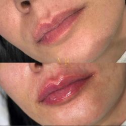 preenchimento-labial-antes-e-depois (4)