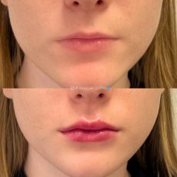 preenchimento-labial-antes-e-depois (5)