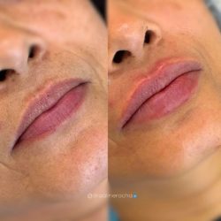 preenchimento-labial-antes-e-depois (6)