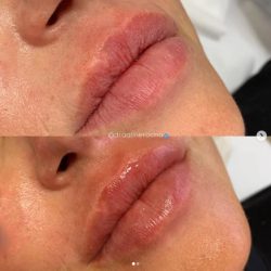 preenchimento-labial-antes-e-depois (7)