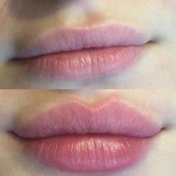 preenchimento-labial