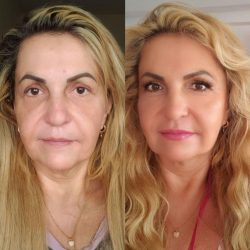 preenchimento-labial-sao-paulo (2)