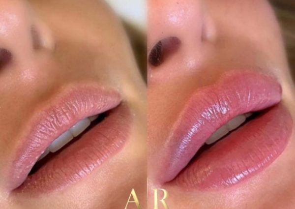 preenchimento-labial-sp