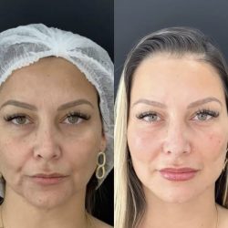 skinbooster-perto.jpg