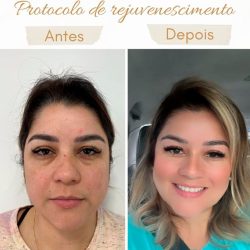 tratamentos-bioestimuladores-de-colageno-2